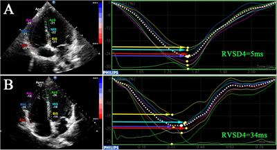 Preliminary Study of Right Ventricular Dyssynchrony Under High-Altitude Exposure: Determinants and Impacts